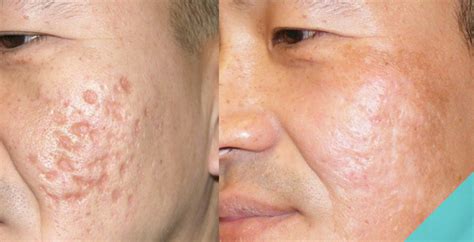 Treatments for Getting Rid of Deep Acne Scars - Spa MD