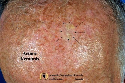 Actinic Keratosis Histology