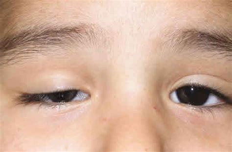 Ptosis Palpebral infantil | Oftalmología Avanzada