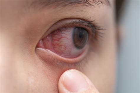 Herpes Eye Infections: Prevention And Treatment | Atlantic Eye Institute