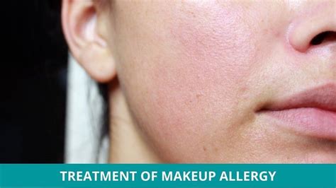 How to Treat Makeup Allergy Naturally?