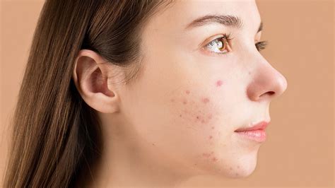 Nodular Acne: Causes, Treatment, Home Remedies And Prevention - Zwivel