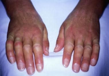 Systemic Scleroderma Hands