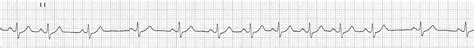 Sinus Arrhythmia • LITFL Medical Blog • ECG Library Basics