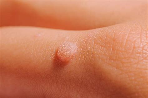 Is There a Medical Treatment for My Warts?: Northstar Dermatology ...