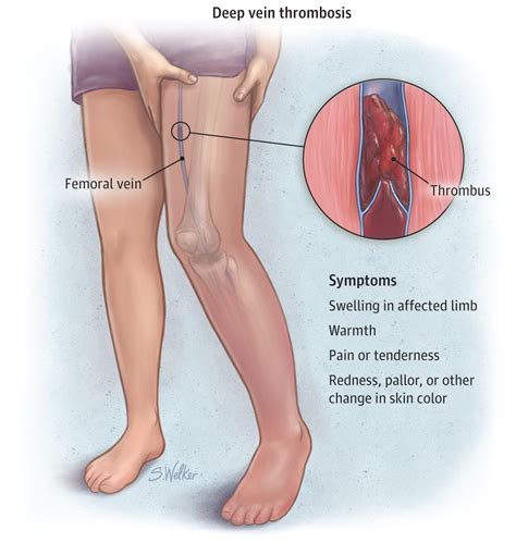 Small Blood Clot In Leg