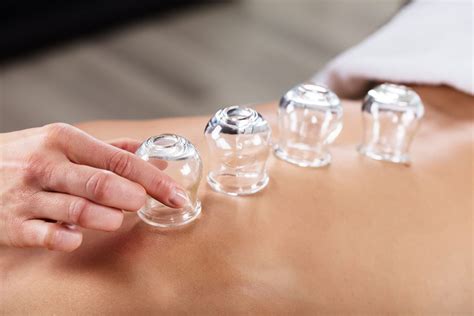 What is Cupping Therapy? The Uses, Benefits, and More