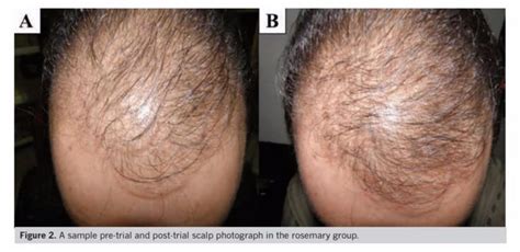 Rosemary Oil For Hair Loss? Not So Fast... (Before and After Photos ...