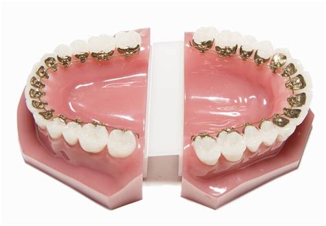 Lingual Braces – sinanak.com