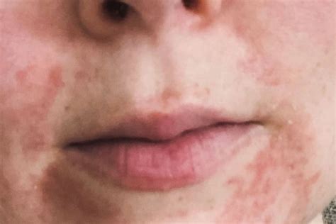 What is perioral dermatitis: All about its causes, treatments and ...