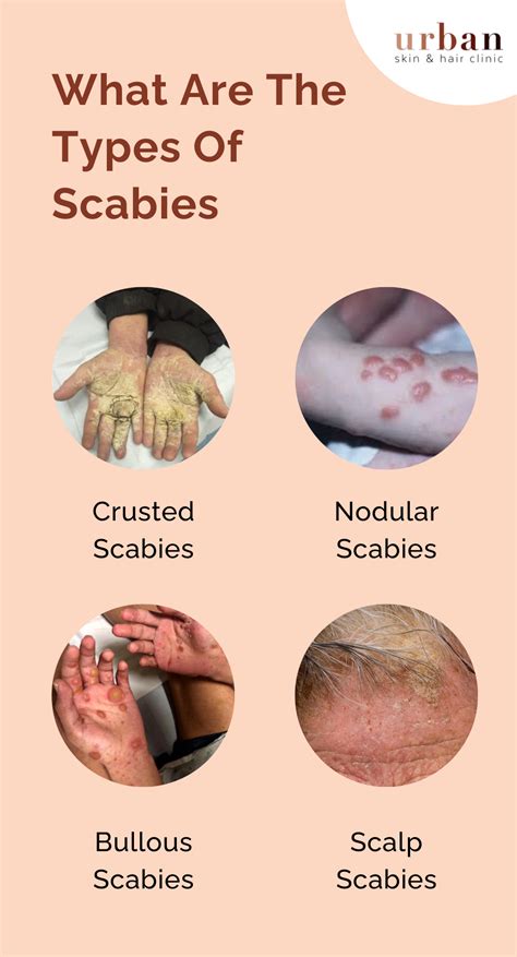 Scabies Types, Causes, Symptoms & Treatment | USHC