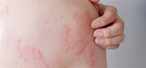 Hives | Dermatology and Skin Health - Dr. Mendese