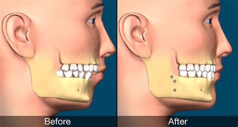 Jaw Surgery Types And Risks | MySmile CT Blog