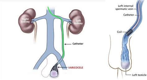 Varicocele Embolisation | Radiology.Wales