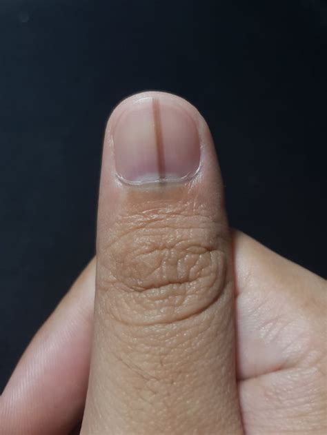 Dark Line on Fingernail : r/Melanoma