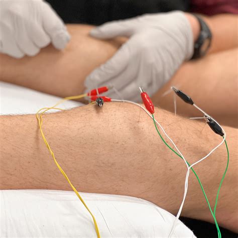 How Dry Needling Therapy Can Help Chronic Pain – MS Physical Therapy