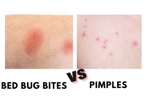 Bed Bug Bites vs Pimples: How Can You Tell? - PestQueen