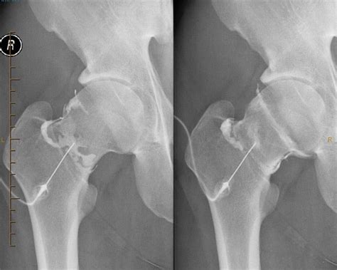 Hip Arthrogram Injection