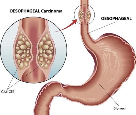 Oesophagus Cancer