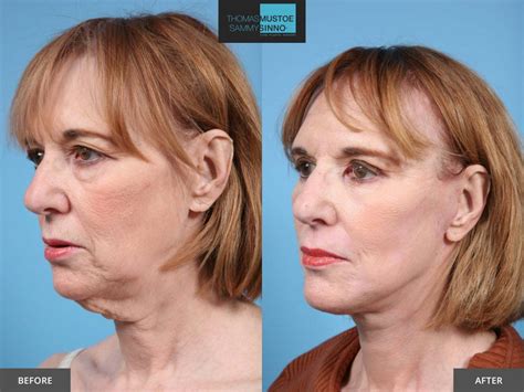 8 Facelift Before-and-After Photos That Prove Just How Natural Today’s ...