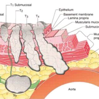 TN Staging of Esophageal Cancer. © Copyright 2001-2015. 1800 Orleans ...