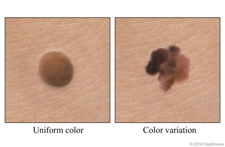 Melanoma skin cancer sign: Color variation Video & Image