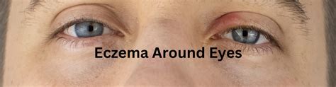 Eczema Around Eyes