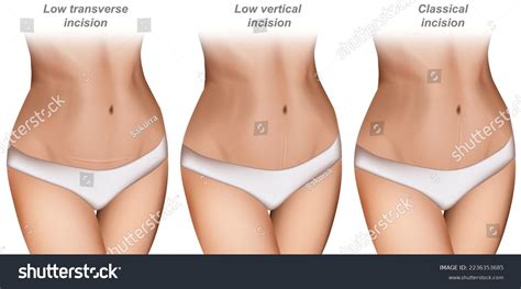 Caesarean Section Scar Low Vertical Incision Stock Vector (Royalty Free ...