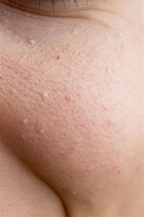 How To Get Rid Of Tiny Bumps On Face Quickly - raktualibecanda