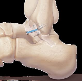 Surgery for Ankle Instability - The Sajid Shariff Clinic