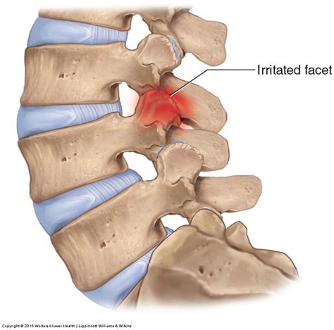 Facet Joint Sprain - Back in Action