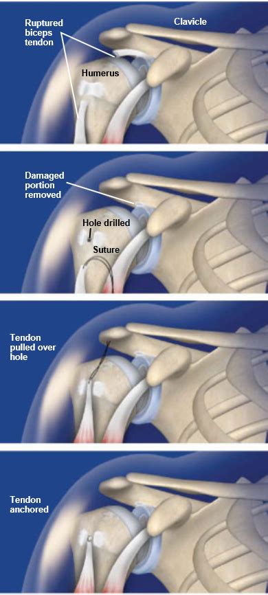 Biceps-Tenodesis | Biceps, Shoulder surgery, Bicep tendonitis