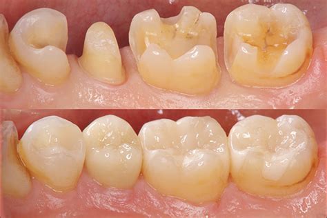 Inlays and Onlays Gambrills, MD | Dr. Antonio Barbaro