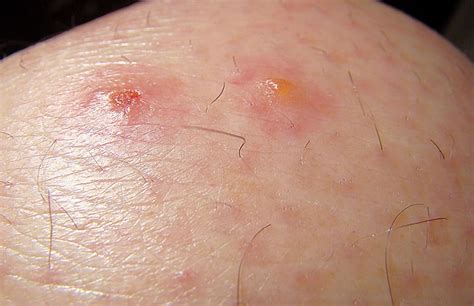 Chiggers Bites Look Like