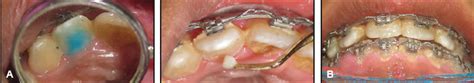 Gradual Grinding of a Talon Cusp During Orthodontic Treatment - JCO ...