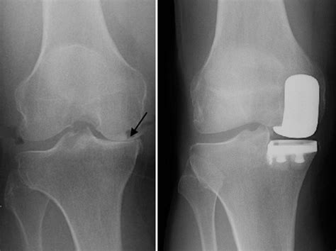 Partial Knee Replacement - Pacific Orthopedics and Sports Medicine