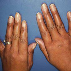 Systemic Scleroderma Hands