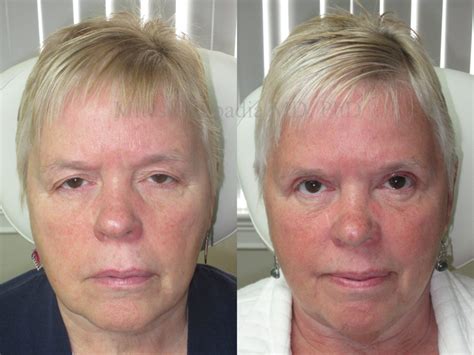 Before and After Ptosis Repair and Eyelid Retraction Surgery Photos ...