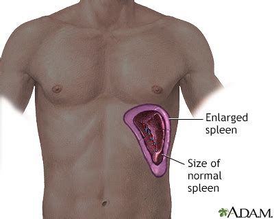 Visceromegaly Symptoms, Doctors, Treatments, Advances & More | MediFind