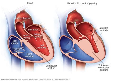 Stiff Heart Syndrome Symptoms - Quotes Marco