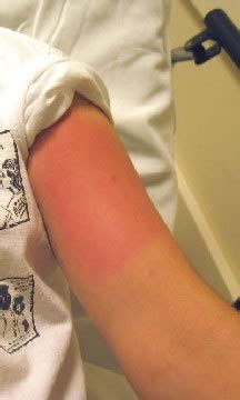 Yellow Jacket Sting Allergy