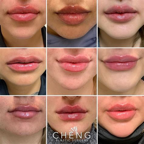 Cheng Plastic Surgery & Medspa on Instagram: “Lip Inspo ⁣ ⁣ Here is ...