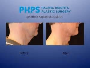 Adam's Apple Surgery - How to Get it Back | Pacific Heights