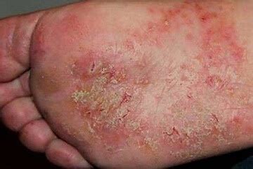 Foot Eczema: Causes, Symptoms & Treatment - Foot Pain Explored (2022)