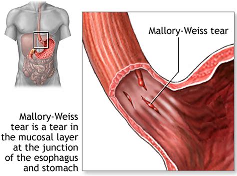 Mallory Weiss syndrome symptoms, causes, diagnosis and treatment