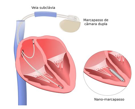 Arritmia Cardiaca