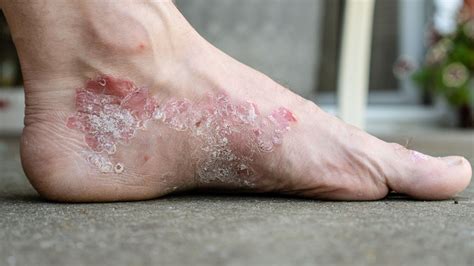 Eczema vs. Psoriasis: Similarities, Differences and Treatments