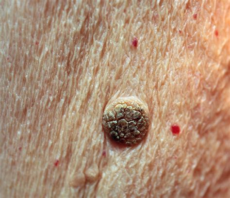 ‍Seborrheic Keratosis | Treasure Valley Dermatology | Dr. Dustin Portela