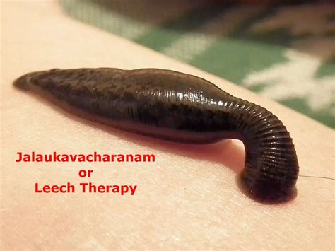 Know About The Quirky Leech Therapy And Its Benefits