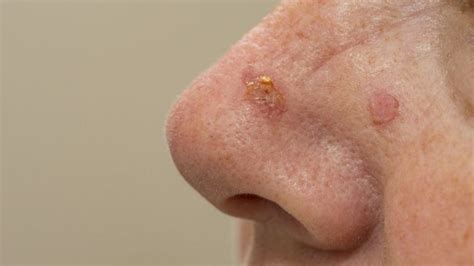 Actinic Keratosis: Symptoms, Causes, & Treatment - Toronto Dermatology ...